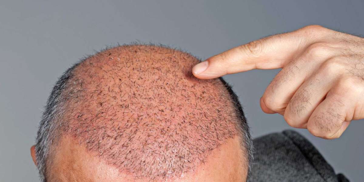 Scalp Micropigmentation Treatment