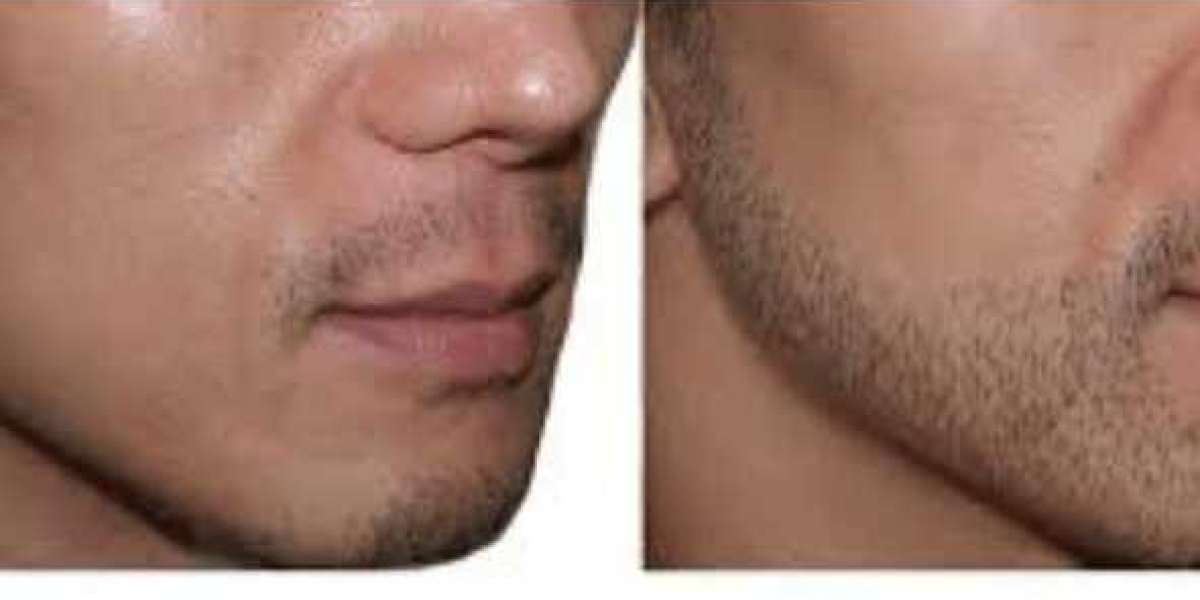 Facial Hair Transplant