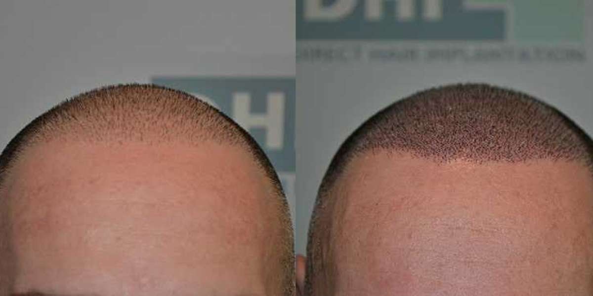 Hair Micropigmentation Cost