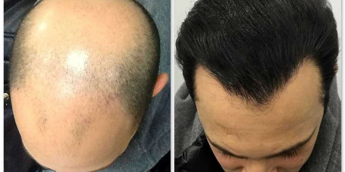 Hair Transplant Palm Springs