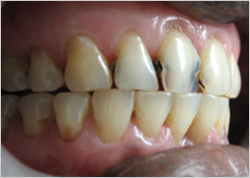 Painless Wisdom Tooth Removal, Tooth Filling & Root Canal Treatment in Surat