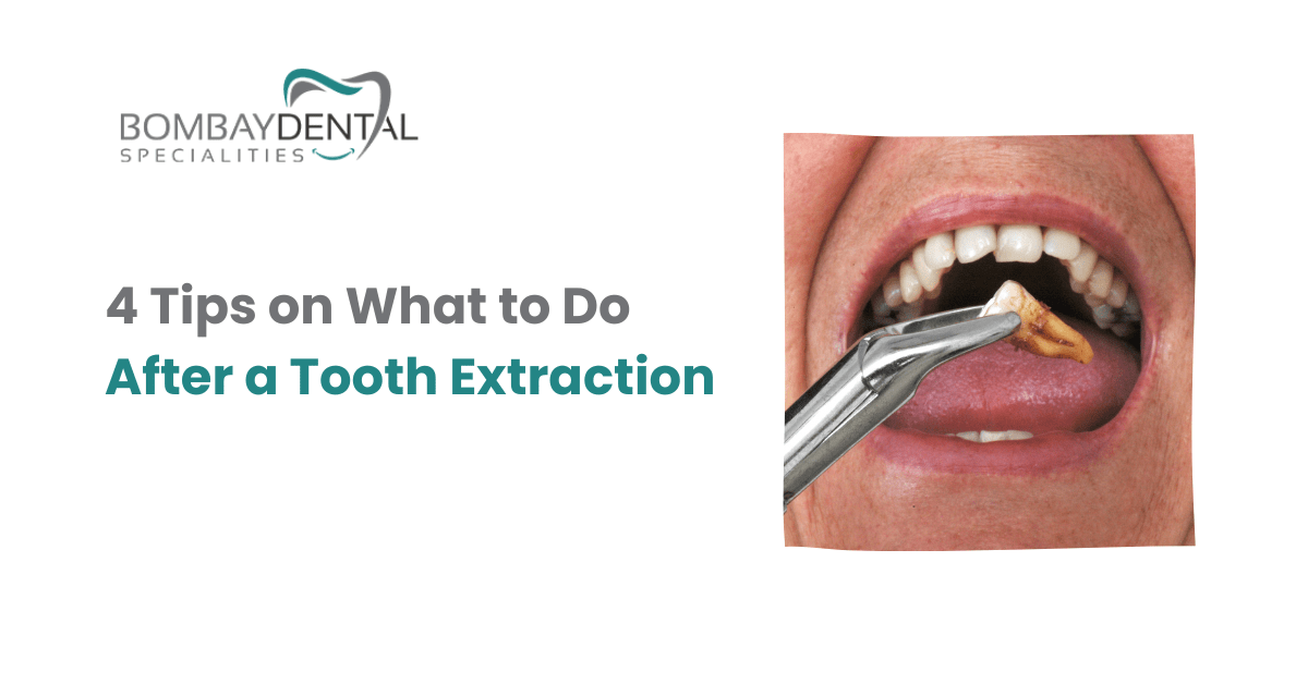 4 Tips on What to Do After A Tooth Extraction | Tips for After a Tooth Extraction