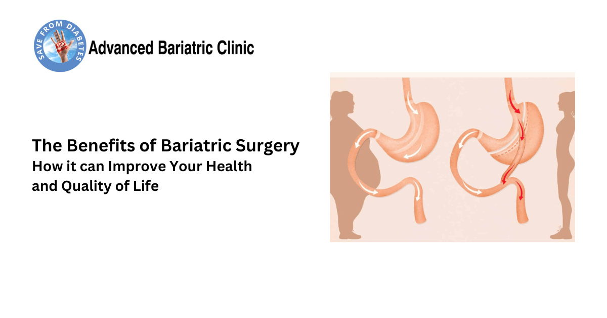 The Benefits of Bariatric Surgery: How it can Improve Your Health and Quality of Life