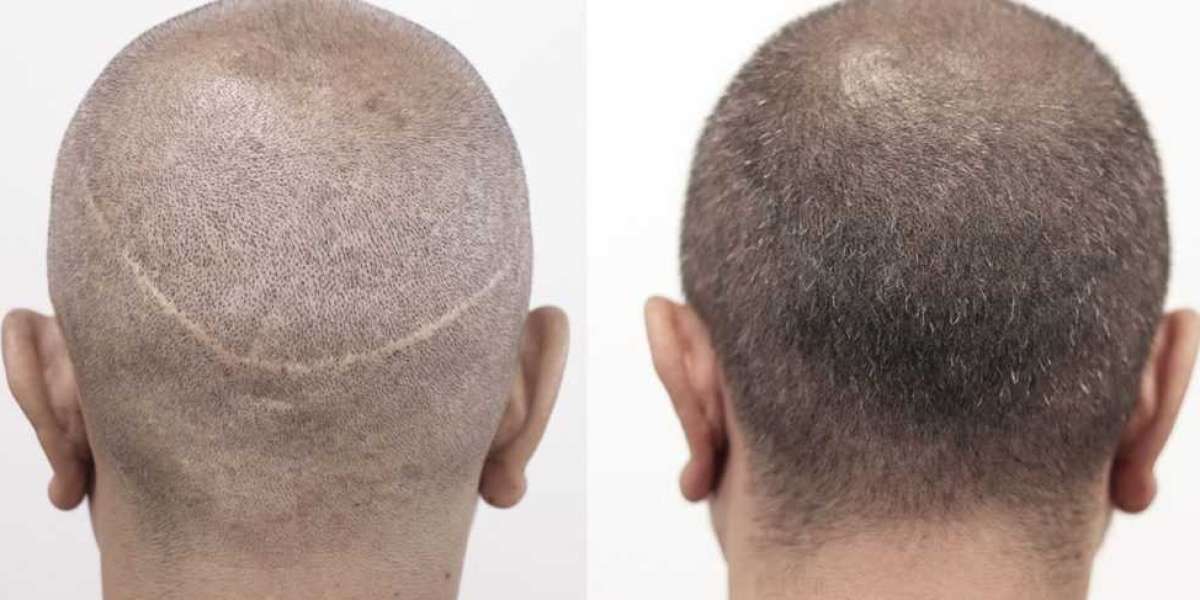 trasplante de cabello de unidad folicular