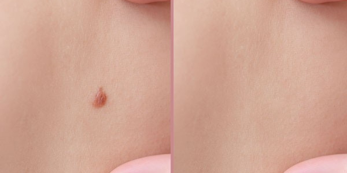 Can Moles Be Removed Permanently?