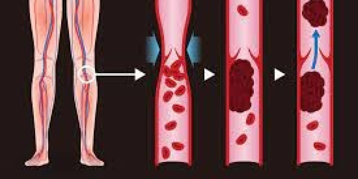 Deep Vein Thrombosis Market Size, Epidemiology, Analysis & Trends 2023-2033