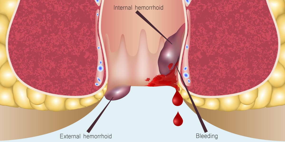 Hemorrhoids Treatment Market Research Destined the Industry to Witness a Rapid Expansion over 2030