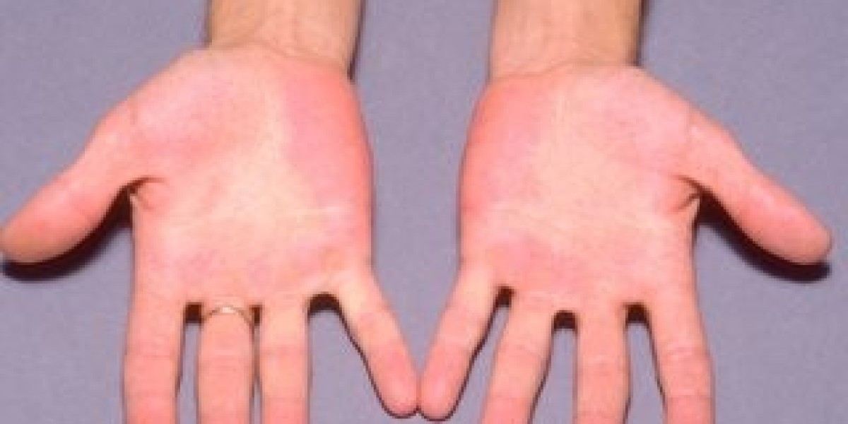 Erythromelalgia Market Share, Epidemiology, Analysis & Trends 2023-2033