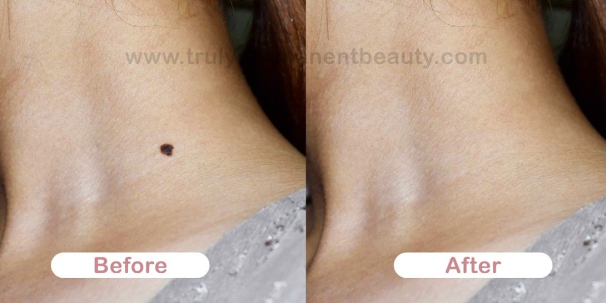 Will laser treatment help remove flat moles?