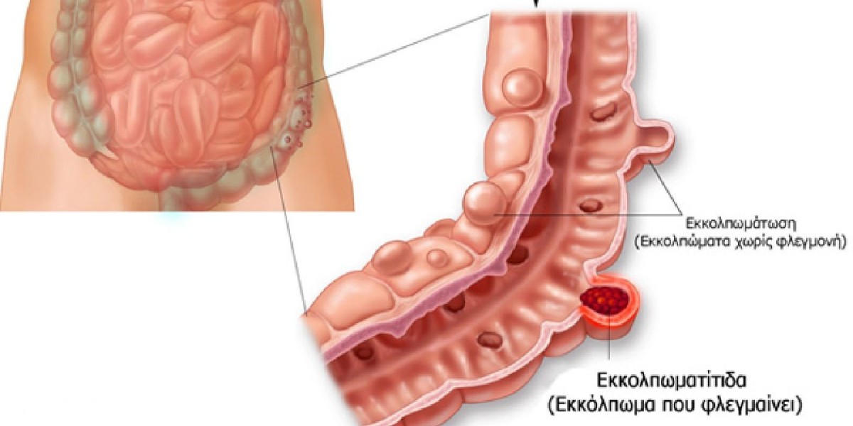 Diverticulitis: What You Need to Know About this Digestive Disorder