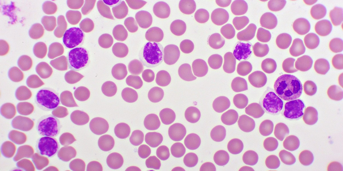 Chronic Lymphocytic Leukemia Market Analysis Report 2023 Along with Statistics, Forecasts till 2033