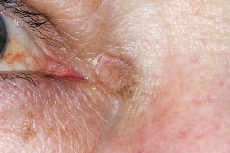 Actinic Keratosis on the Eyelids: Protect Your Eyelids - Herbal Care Products