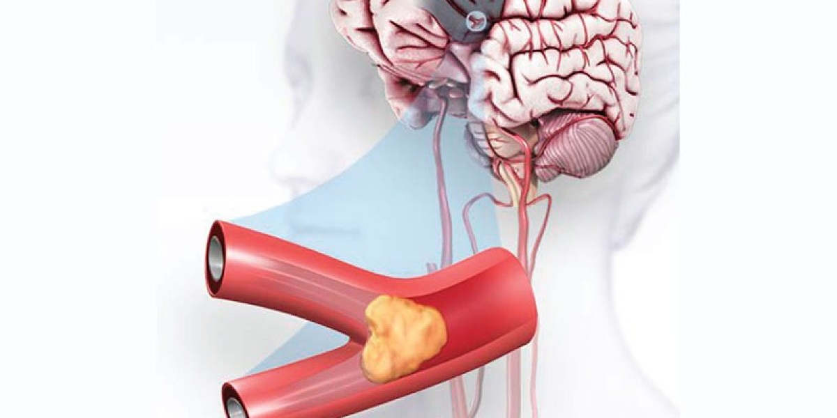 Ischemic Stroke Market Share, Epidemiology, Analysis & Trends 2023-2033