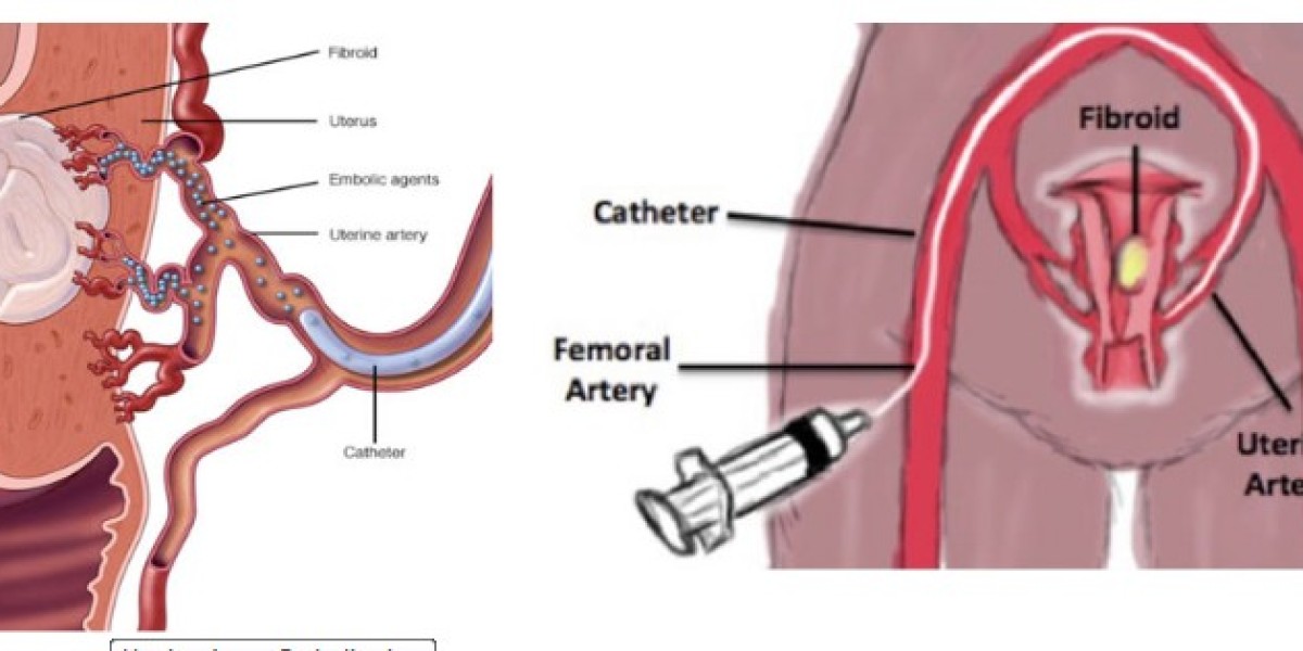 Uterine Fibroid Treatment In India