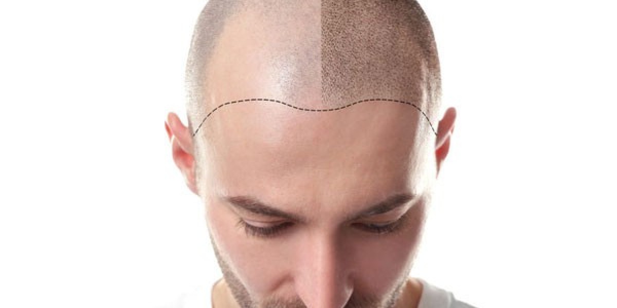 Hair Transplant Surgery In Delhi