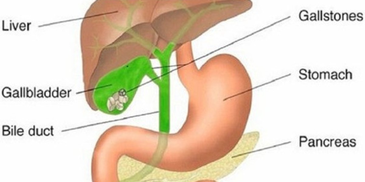 Gallbladder Stone Surgery in Delhi