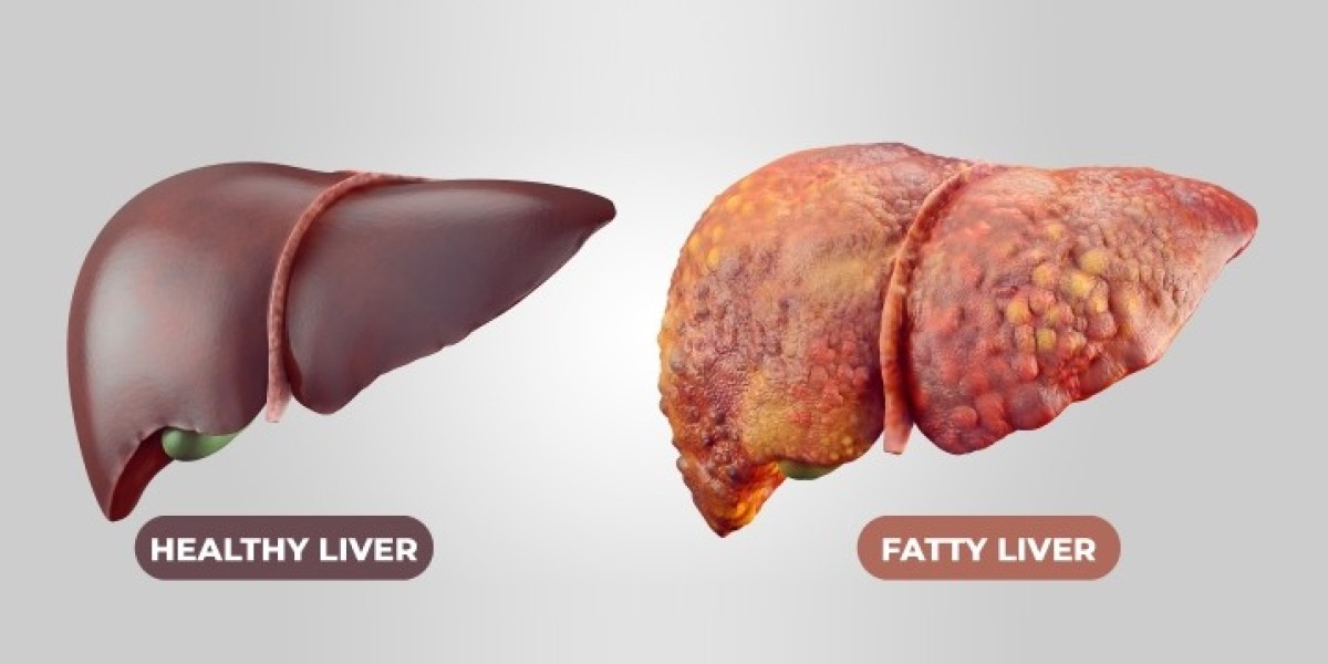 Non-Alcoholic Steatohepatitis (NASH) Market Global Industry Trends, Share, Forecast 2023-2028