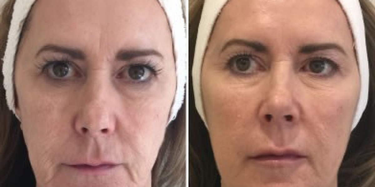 Revolutionizing Skin Rejuvenation: Profhilo in Leeds