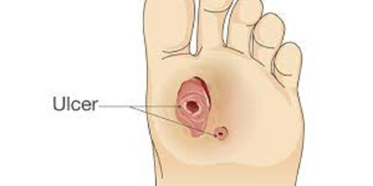 Diabetic Foot Ulcers Market Analysis, Epidemiology, Trends and Forecast till (2023-2033)