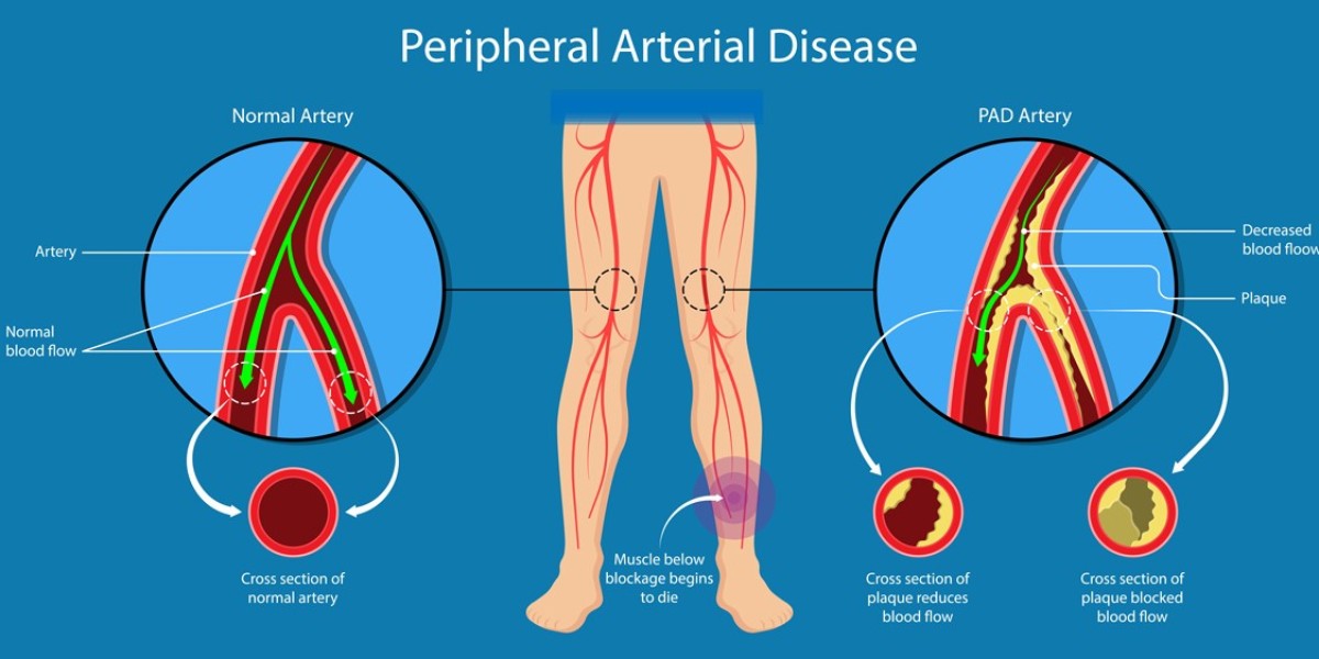 Navigating PAD: A Comprehensive Guide to Diagnosis and Treatment Trends