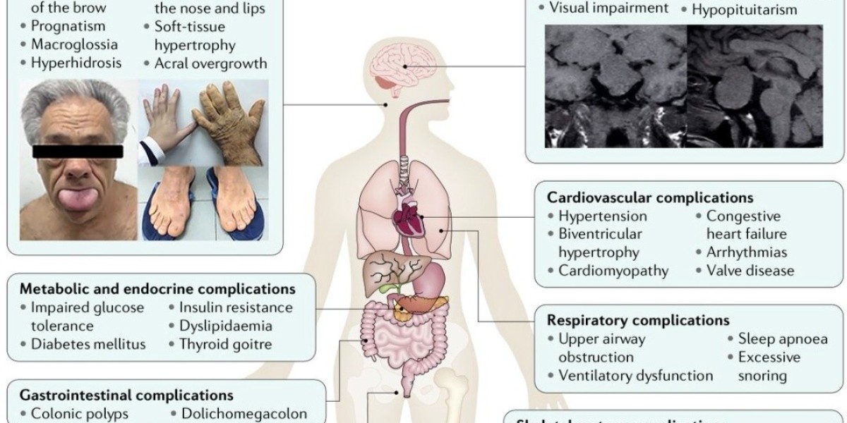 Navigating Acromegaly: Understanding Symptoms, Diagnosis, and Therapies