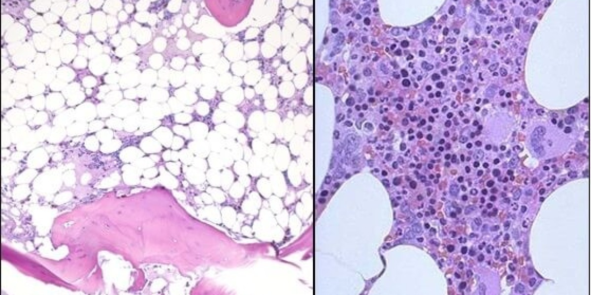 Congenital Bone Marrow Failure Syndromes Market Analysis Report 2023 Along with Statistics, Forecasts till 2033