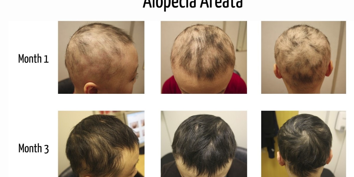 Innovations in Alopecia Areata: A Comprehensive Analysis