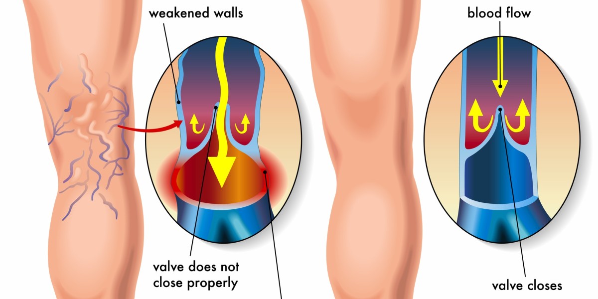 Eclipsing Veins: Illuminating the Latest in Varicose Vein Research