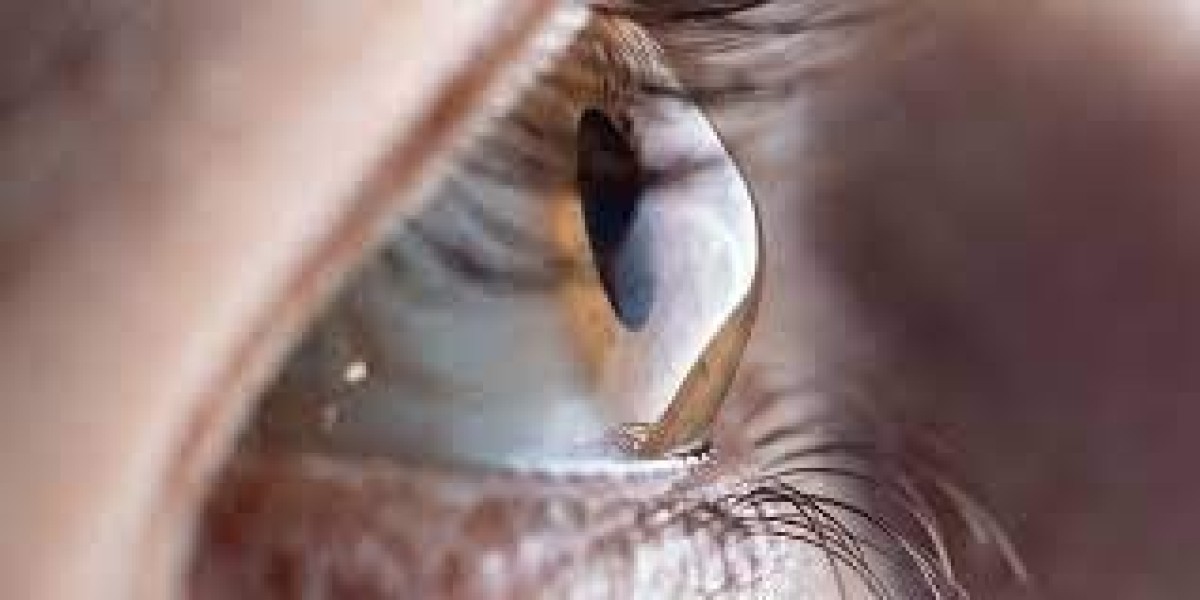 Keratoconus Market Research | 2024-2034