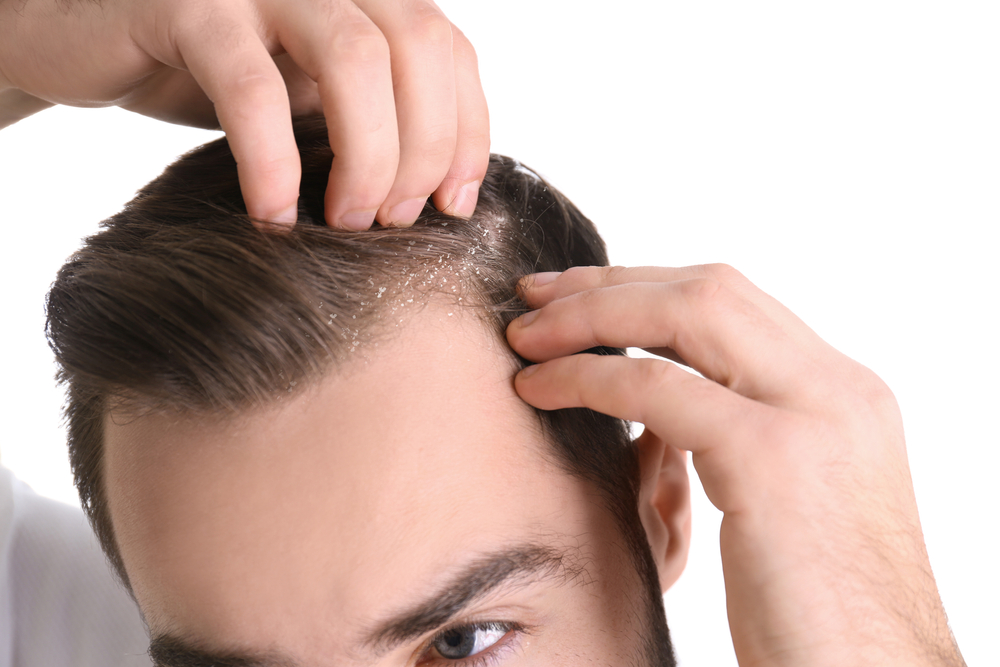 Is Dandruff Ruining Your Confidence?