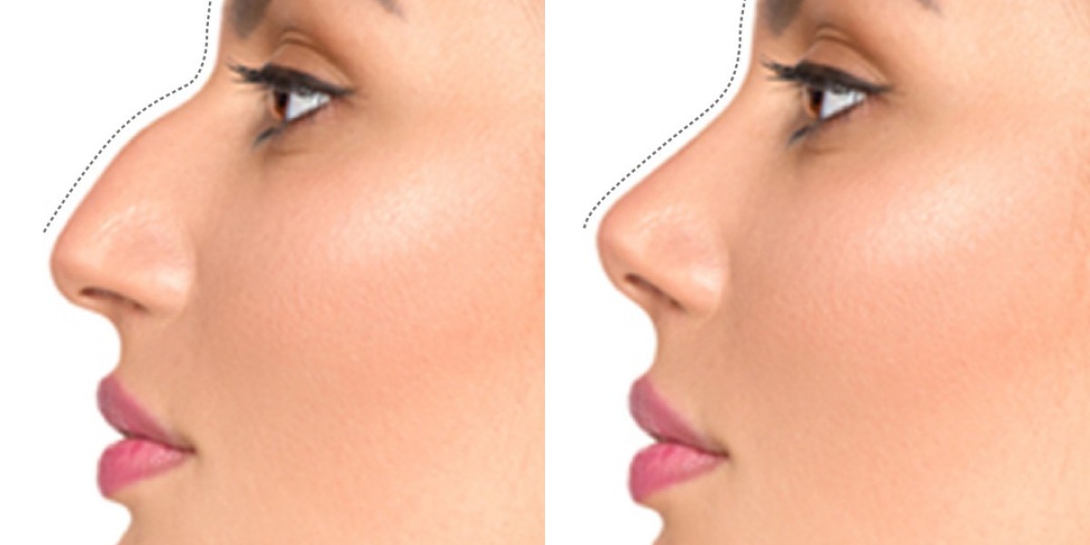 Do I Need Open or Closed Rhinoplasty?