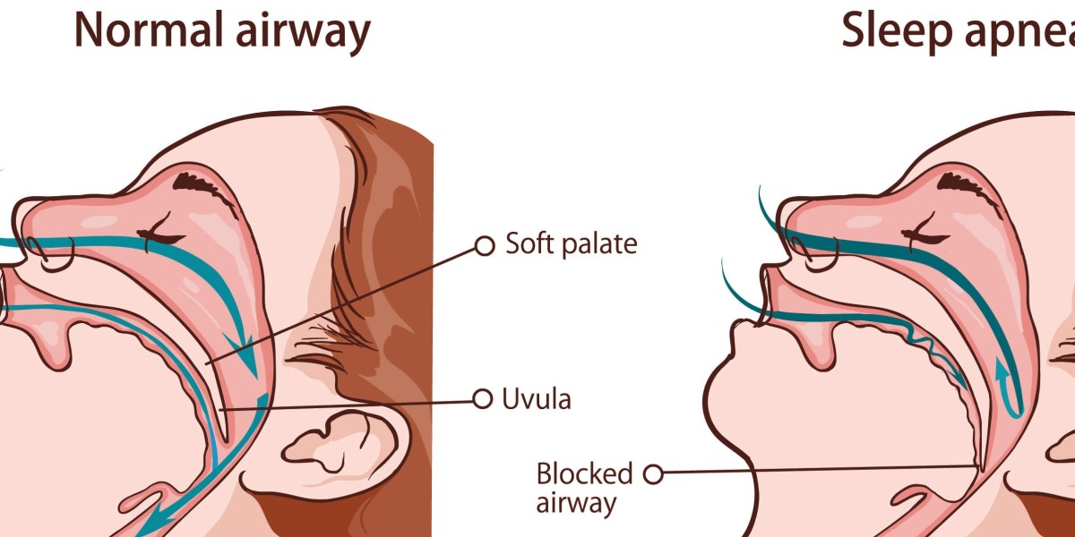 Breathing Easy: Innovations Driving Growth in the Sleep Apnea Device Market