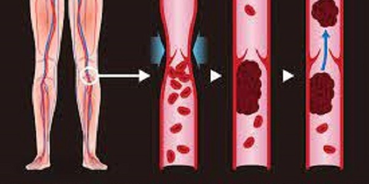 Deep Vein Thrombosis Market Share, Epidemiology, Analysis & Trends 2024-2034