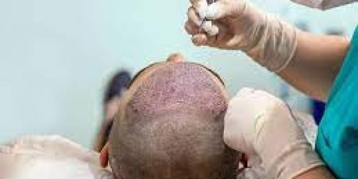 Hair Transplant cost in Bangalore