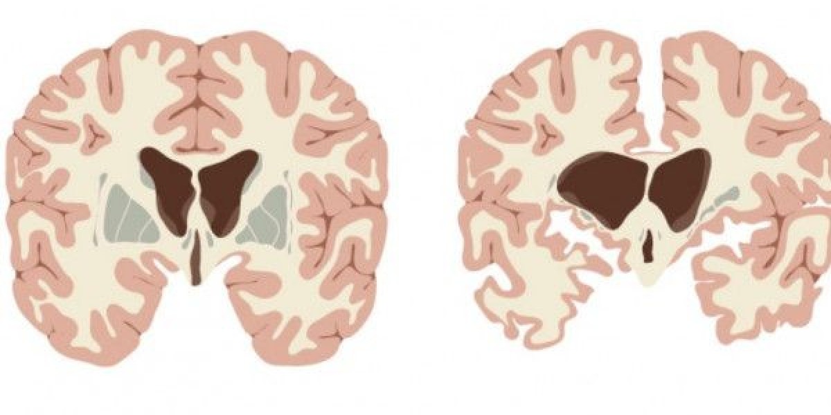 Transformative Trends: Shifts in Huntington’s Disease Treatment Market Dynamics