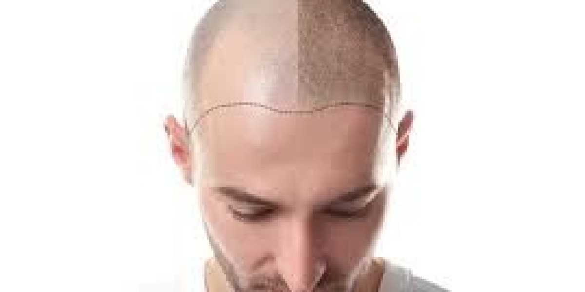 Best Hair Transplant in Nashik