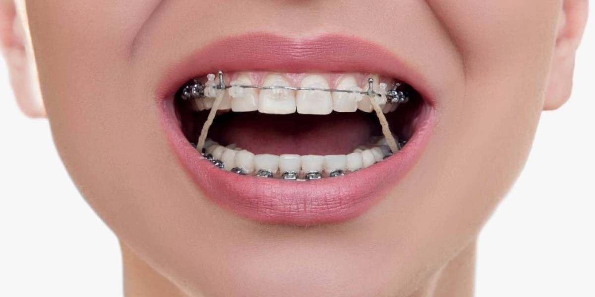 Lingual Orthodontics Brackets Market Analysis,  Applications and Forecast 2030