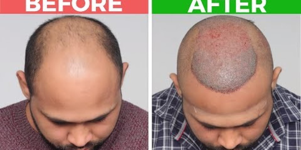 Hair Transplant in Karachi | Cost, Steps & Best Clinic