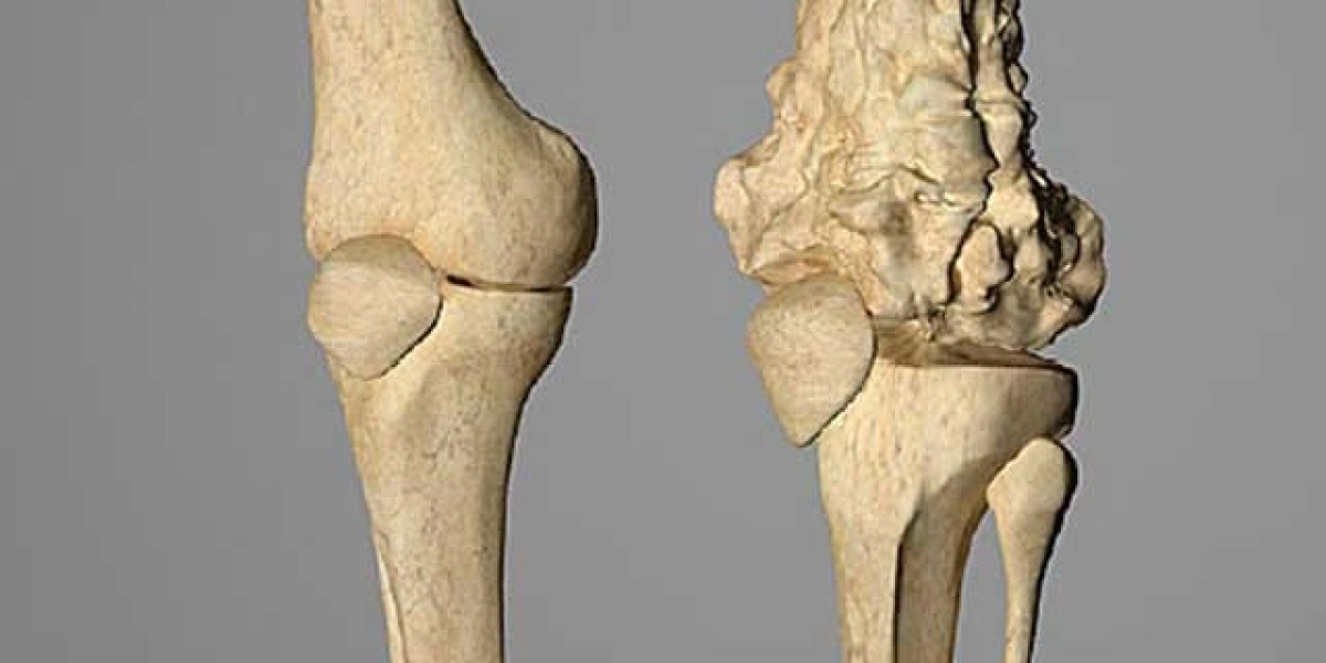 Osteosarcoma Market Companies, Market Trends & Analysis till 2034