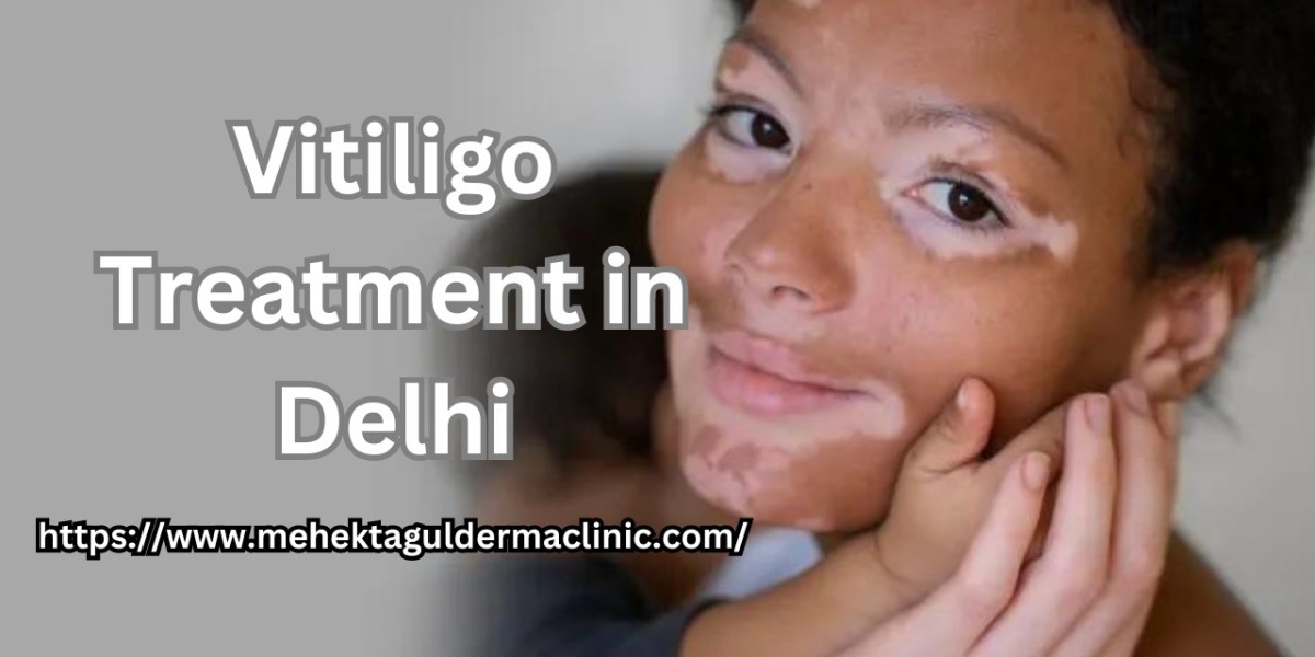 What are the best treatments for vitiligo?