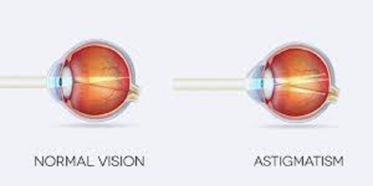 Astigmatism Market