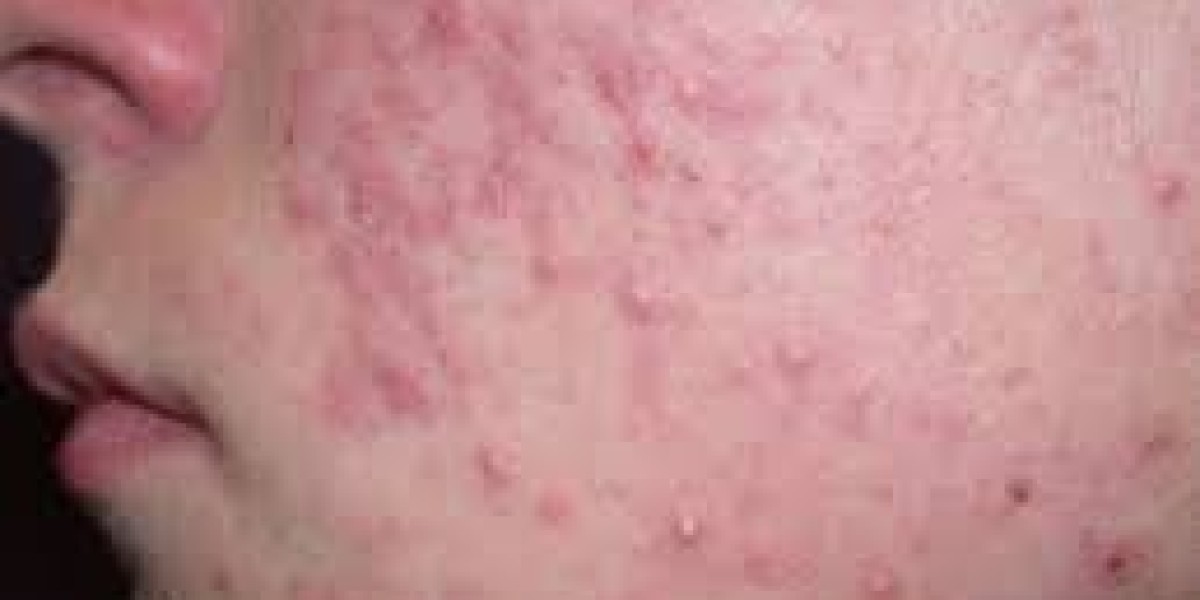 2024 Acne Vulgaris Market | Report By 2034