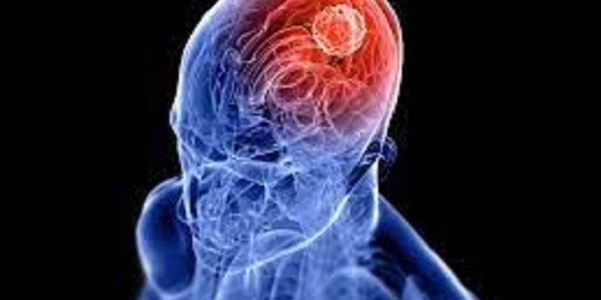 Glioma Market Share, Epidemiology, Analysis & Trends 2024-2034