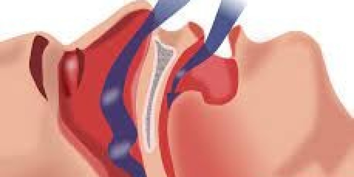 Obstructive Sleep Apnea Market Share, Epidemiology, Analysis & Trends 2024-2034