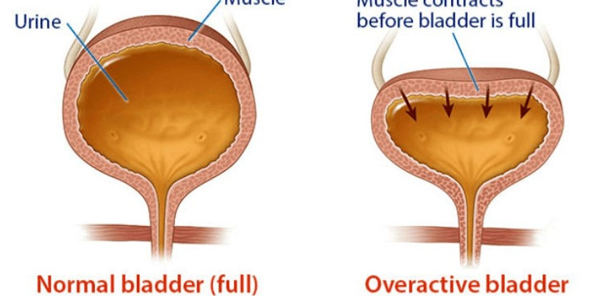 Overactive Bladder Market Research | 2024-2034