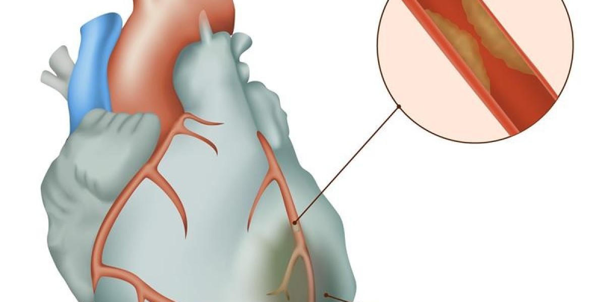 Myocardial Infarction Market Growth, Forecast to 2034