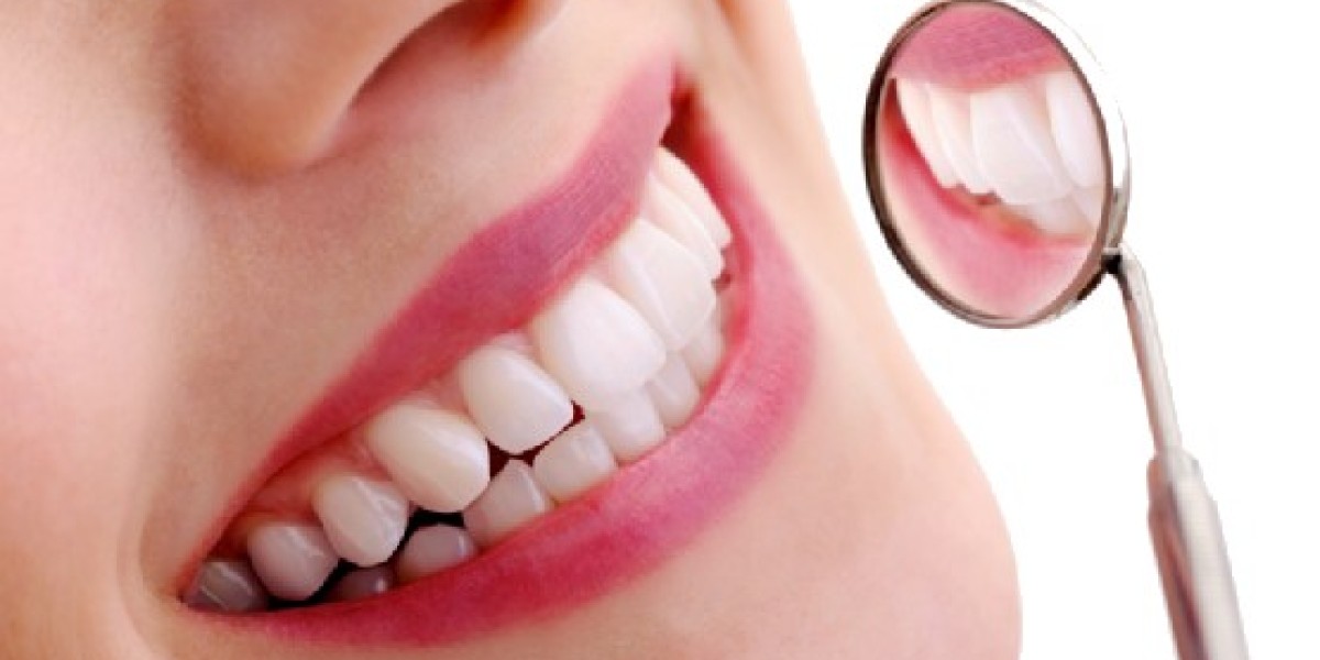 White Fillings in Wimbledon: A Modern Solution for Cavity Treatment