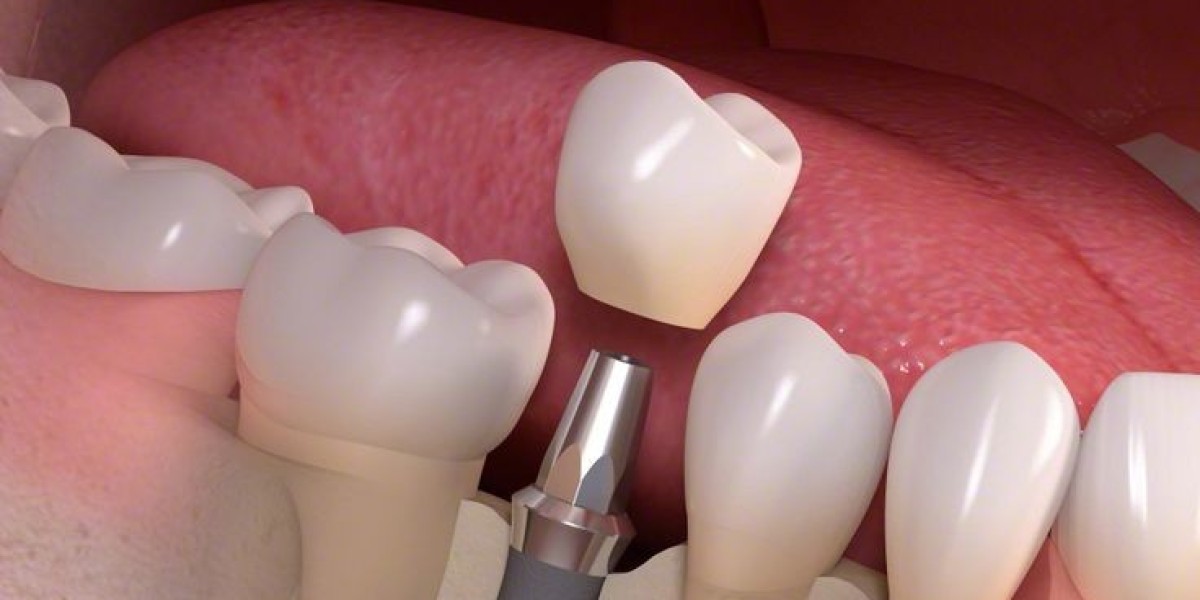 Dental Implants: The Ultimate Solution for Tooth Replacement