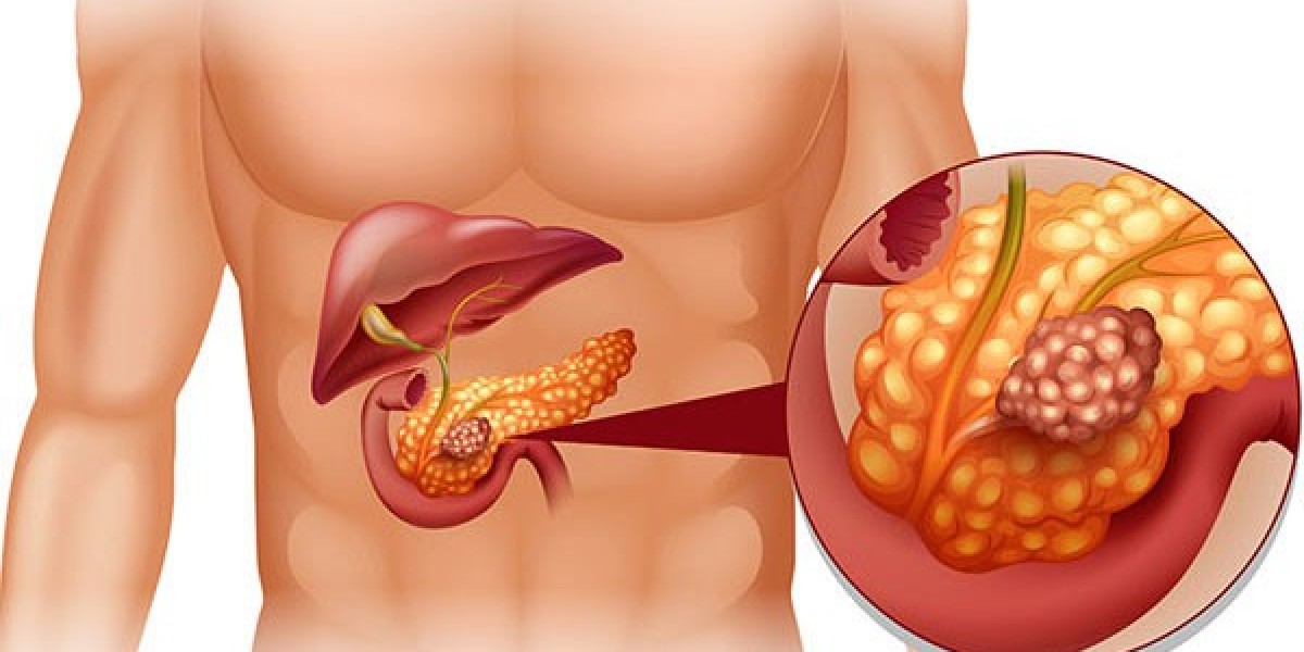 Gallbladder Cancer: What You Should Know