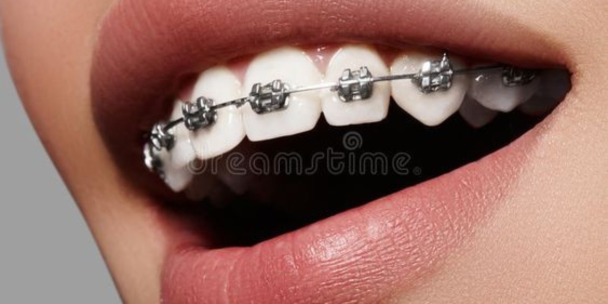 Best Orthodontic Services in Derby: Straighten Your Teeth with Confidence